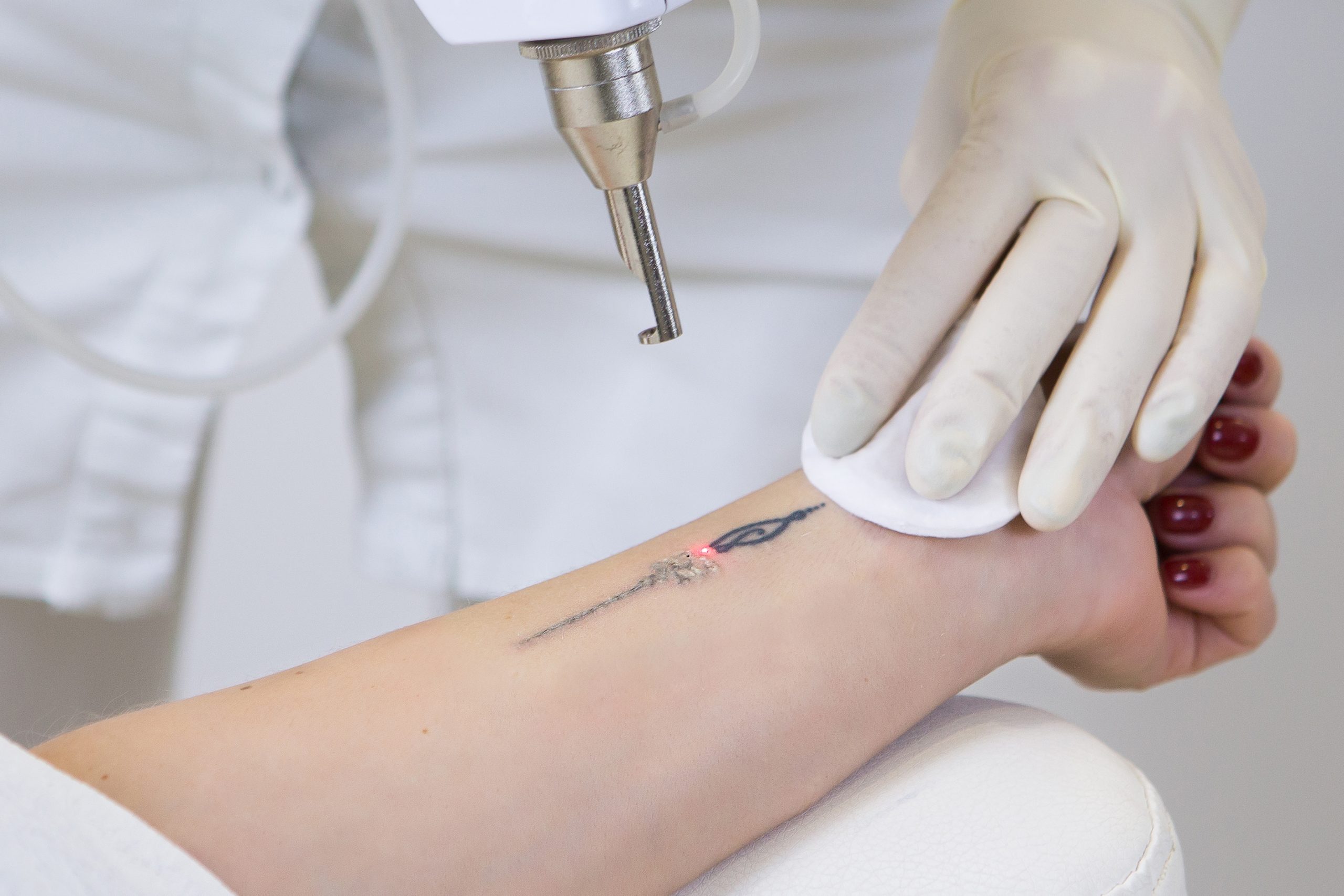 Laser Tattoo Removal - Gresford Skin & Laser Clinic : Gresford Skin & Laser  Clinic